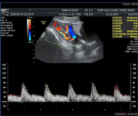 Normal Uterine Artery Doppler Waveform. | Download Scientific Diagram