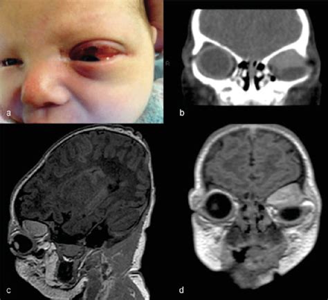 (a) Left-sided proptosis with subconjunctival hemorrhage. (b) CT ...