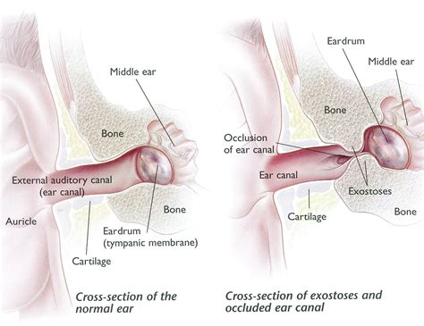 Exostoses Surfer's Ear - Dr Bridget Clancy | ENT Surgeon