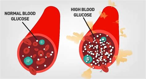 Blood Sugar Guide: does high blood sugar cause ketoacidosis