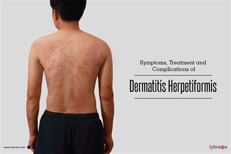 Symptoms, Treatment and Complications of Dermatitis Herpetiformis - Skinology