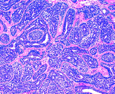 Pathology Outlines - Cylindroma