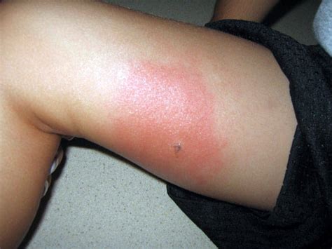 Hindustanlink.com: Health Care Blog » Symptoms Of Mosquito and Insect Bite