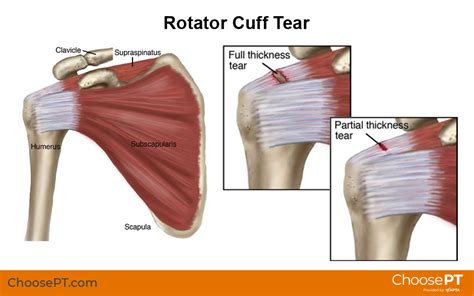 Supraspinatus Muscle Tear