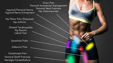 Hip Pain Location Diagram | Hip Pain Location Chart