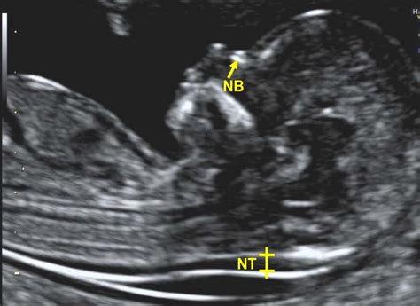 Nuchal Translucency Scan (NT) | MNSonography