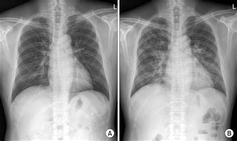 (A) Normal chest radiograph on 3 days before admission. (B) Chest ...