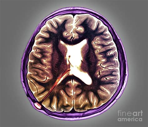 Hydrocephalus Treatment Photograph by Zephyr/science Photo Library - Pixels