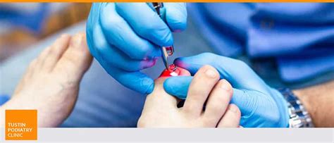 Fungal Nail Treatment Near Me in Tustin CA | Tustin Podiatry Clinic