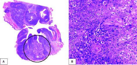 Histopathological findings. Squamous cell carcinoma (black circle) in... | Download Scientific ...