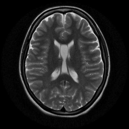 Cavum vergae | Radiology Reference Article | Radiopaedia.org