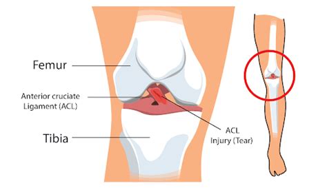 ACL Ruptured - All You Need to Know - Centeno-Schultz Clinic