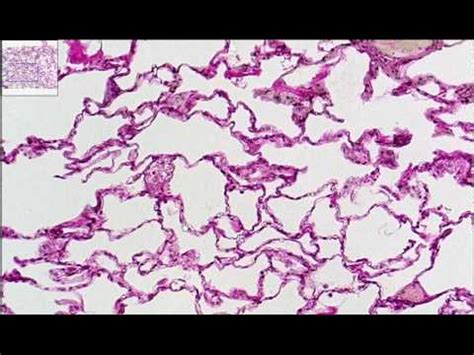 Simple Squamous Lung.mp4 - YouTube