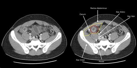 Base Of Appendix