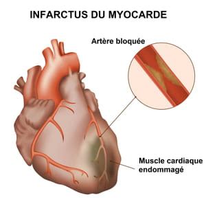 C'est quoi un arrêt cardiaque ? Quels symptômes