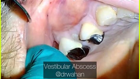 Vestibular Abscess Incision and Drainage Step- by-Step with tooth ...