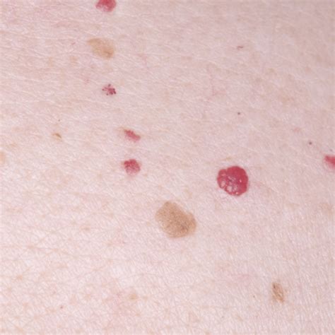 Effective Cherry Angioma Removal | Treatment at Eden Medical