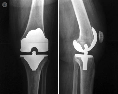 grande productos quimicos Rápido cuanto vale una radiografia de rodilla ...