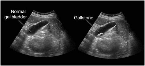 Diseased Gallbladder Ultrasound