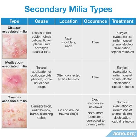 What Are Milia, and Do They Relate to Acne? - Acne.org