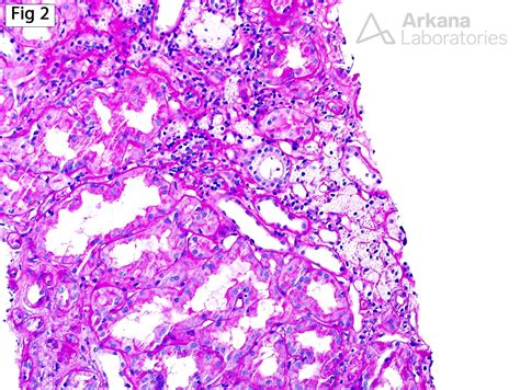 Alport Syndrome | Teaching Points | Arkana Laboratories