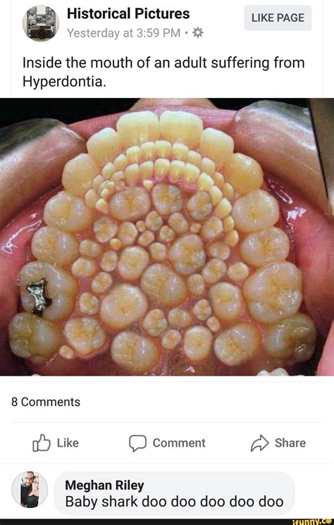 Inside the mouth of an adult suffering from Hyperdontia. - iFunny