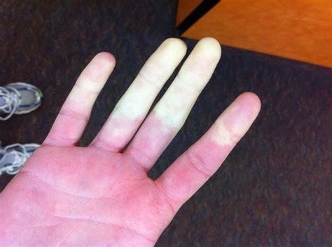 Raynaud's Disease - Dr. Hunter Hoeper