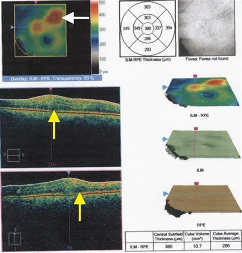 Diabetic Macular Edema