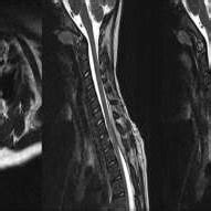 Axial and sagittal MRI images showing spinal cord epidural hematoma | Download Scientific Diagram
