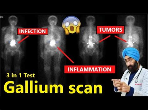 What is Gallium scan | Test to looks for infection, inflammation, and tumors | Dr.Education ...