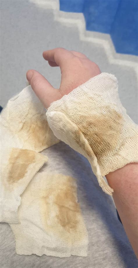 Healing process of a 2nd degree boiling water burn : r/MedicalGore