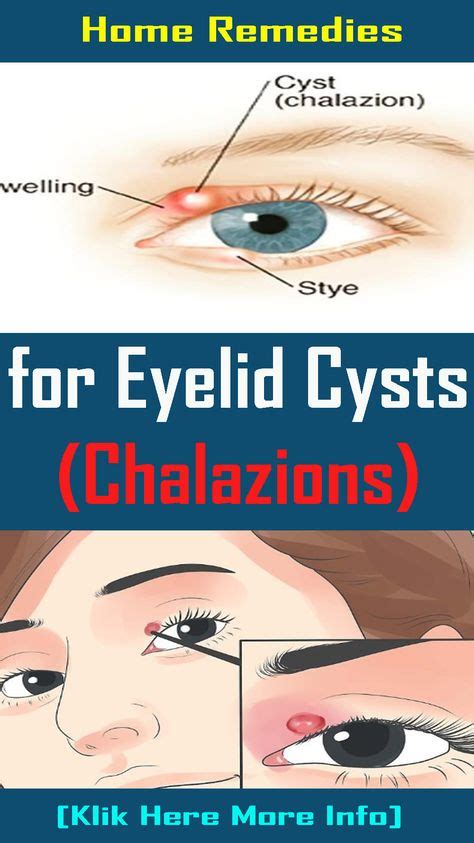 7 Best Eye cyst images in 2019 | Eye cyst, Remedies, Stye remedy