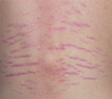 Stretch Marks Explained: Causes, Prevention, and Treatments - StretchMarks.org