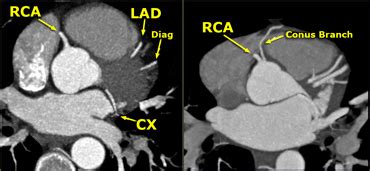 The Radiology Assistant : Coronary anatomy and anomalies