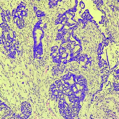 Photomicrograph of endometrioid adenocarcinoma showing fused, atypical ...