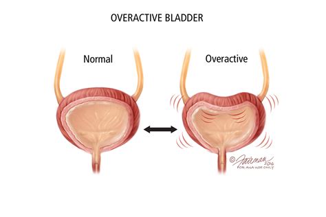 UroPartners - Overactive Bladder