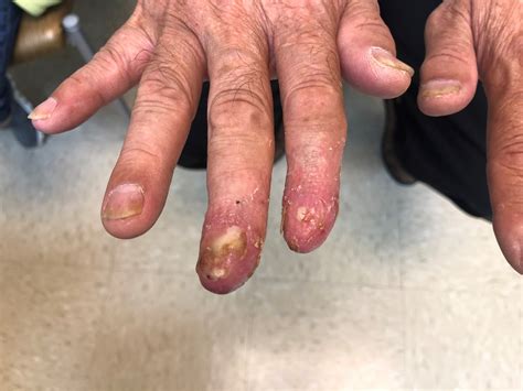 Derm Dx: Painful, Recurrent Rash on the Fingers - Dermatology Advisor