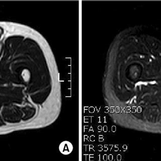 A subcutaneous tumor in the thigh. The tumor is 10×7 cm in size, solid... | Download Scientific ...