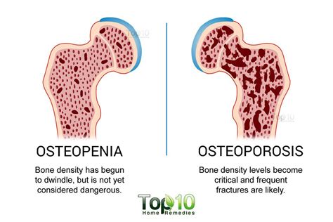 osteopenia and osteoporosis Osteoporosis Bones, Osteoporosis Prevention ...