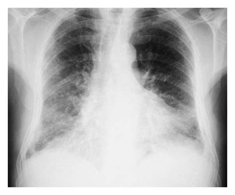 Chest X-ray of a patient diagnosed with combined pulmonary fibrosis and... | Download Scientific ...