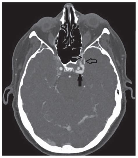 A woman with a red eye from a carotid–cavernous sinus fistula | CMAJ