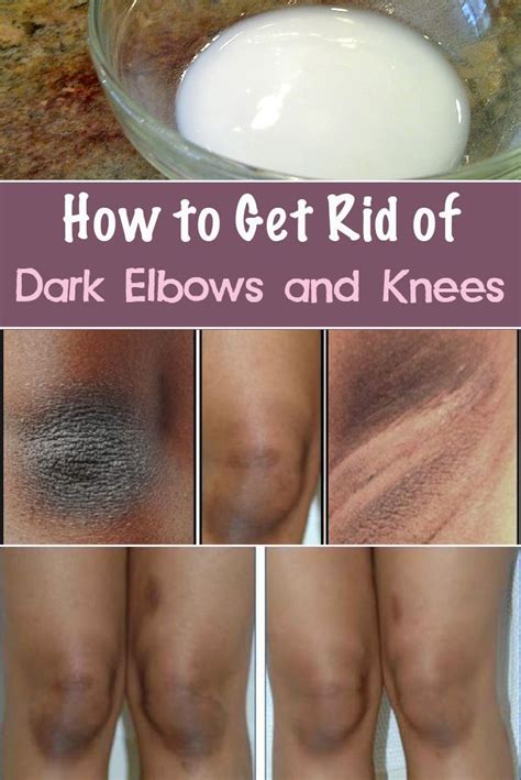 How to Get Rid of Dark Elbows and Knees - Crazy Beauty Tricks | Dark ...