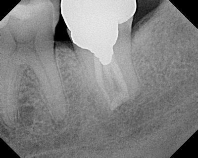 The Endo Blog: Saving the Natural Tooth with Intentional Replantation