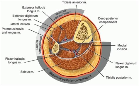 Fasciotomy of the Leg for Acute Compartment Syndrom. | Musculoskeletal Key