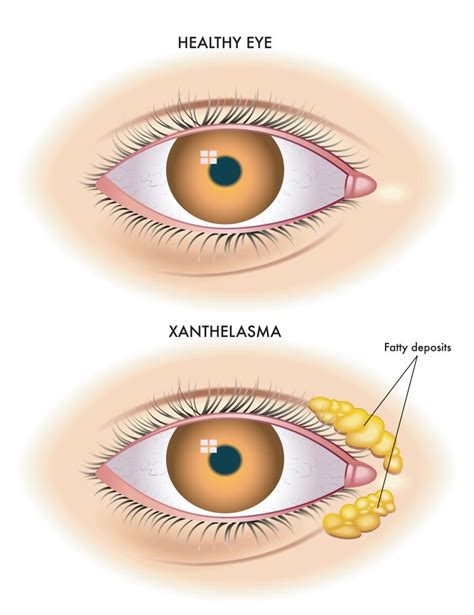 Xanthelasma: Causes, Symptoms and Treatment I Prima Health