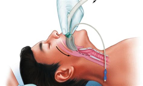 Laryngeal mask airway use tied to less pharyngolaryngeal complications after thyroid surgery