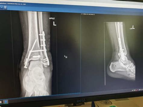 Syndesmotic screw removal after broken ankle?