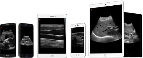 Smartphone-connnected ultrasound probe Clarius gets FDA clearance - iMedicalApps