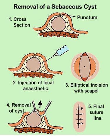 Sebaceous Cyst removal | Cysts, Health skin care, Cyst sebaceous