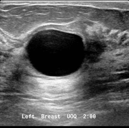 Breast Cyst Ultrasound